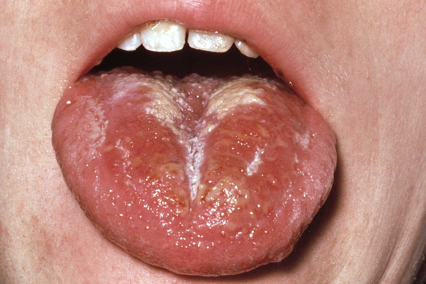 Parents and carers asked to be aware of the symptoms of scarlet fever