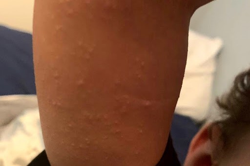 Parents and carers asked to be aware of the symptoms of scarlet fever